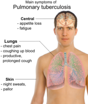Symptoms of Pulmonary Tuberculosis