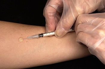 A Mantoux Skin Test