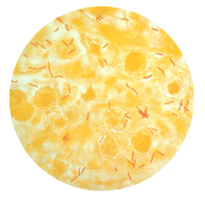 TB bacteria cultured in sputum