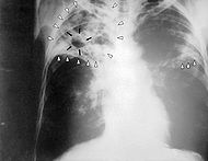 A chest X ray diagnosing advanced active tuberculosis.